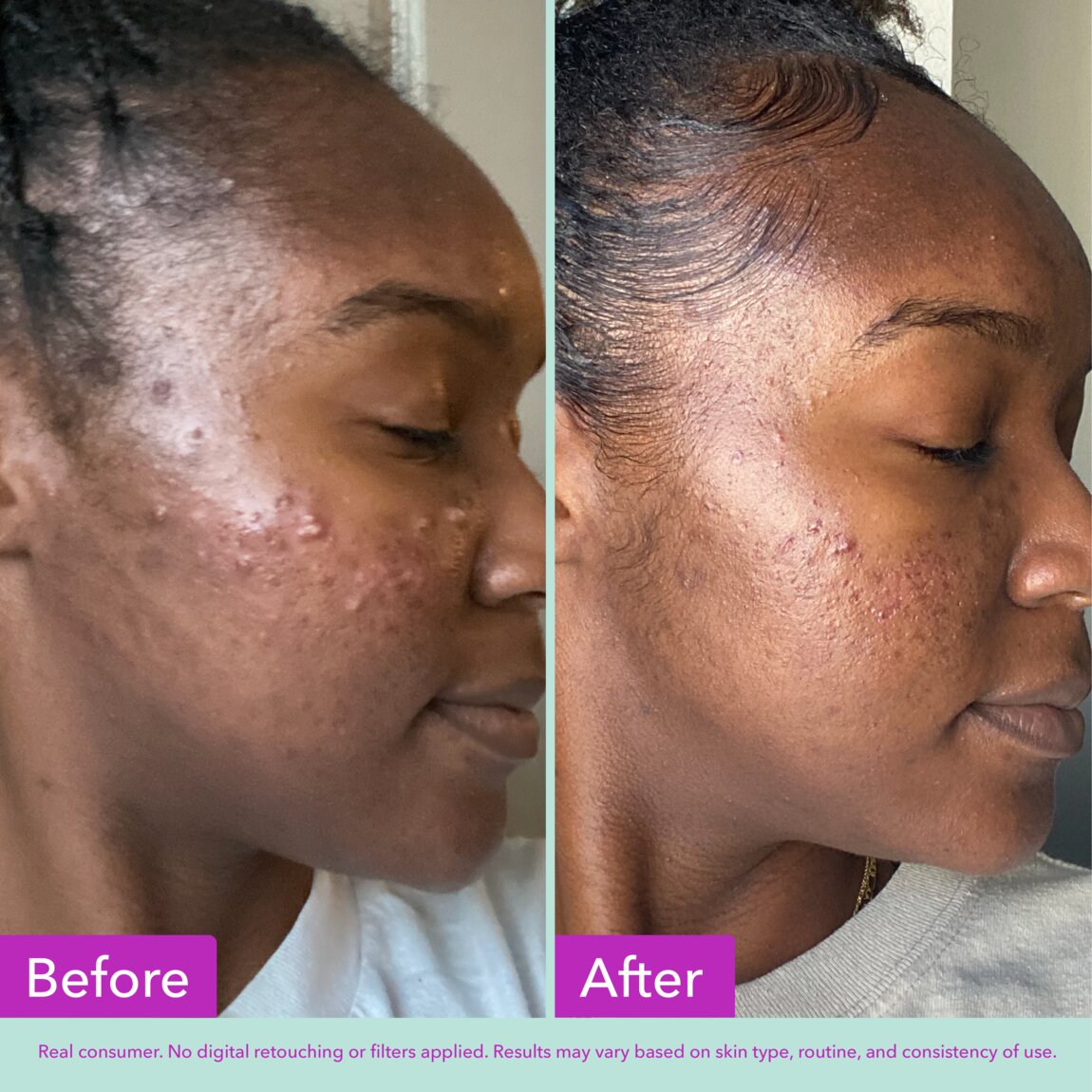 acne-foaming-cleanser-u8 zb_p.jpg